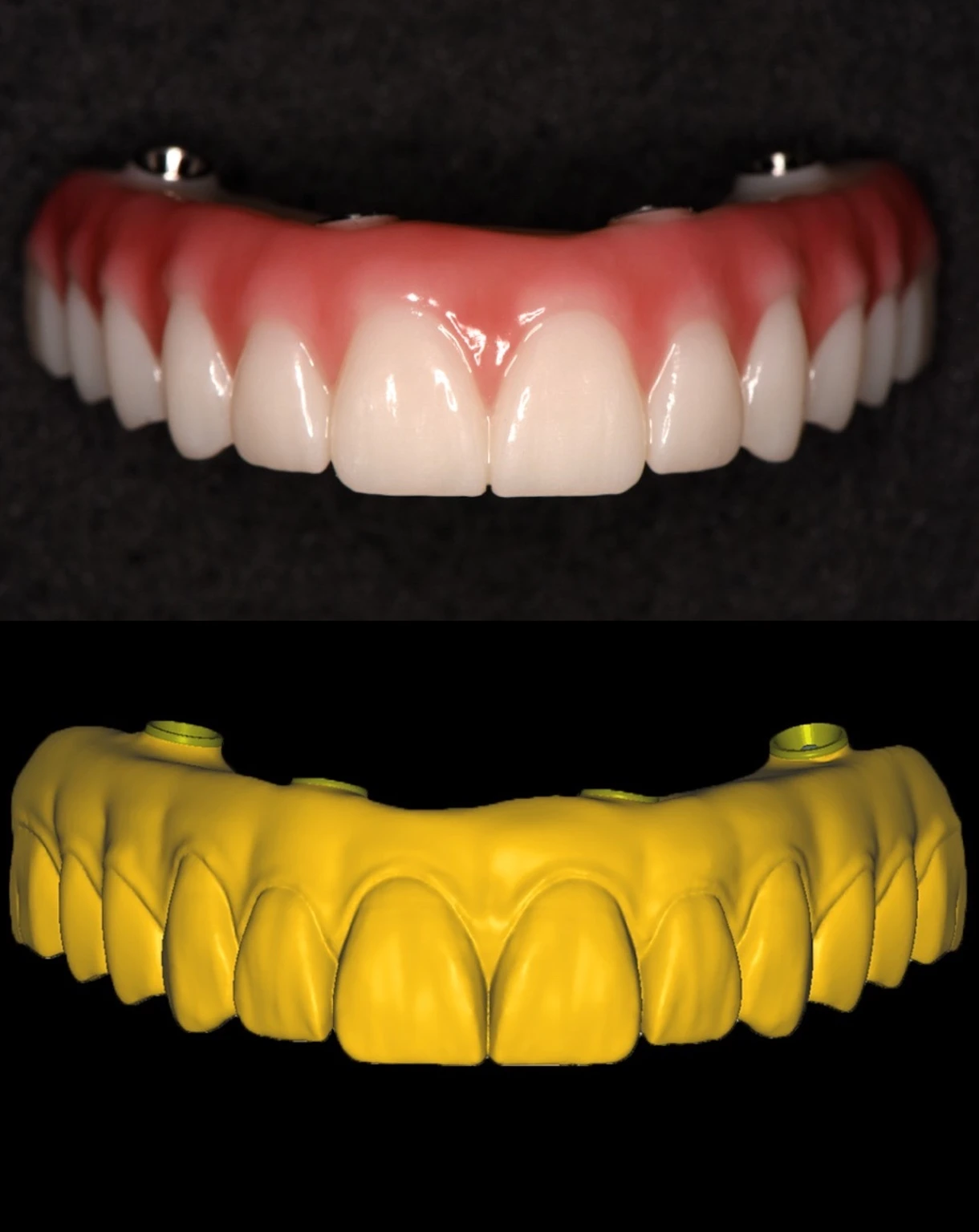 Dash full-arch restoration and digital design