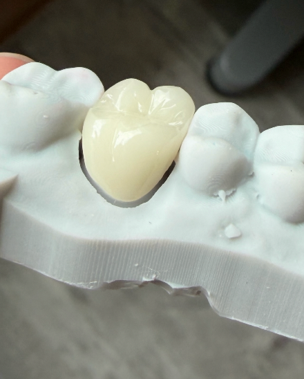A single crown seated on a dental model