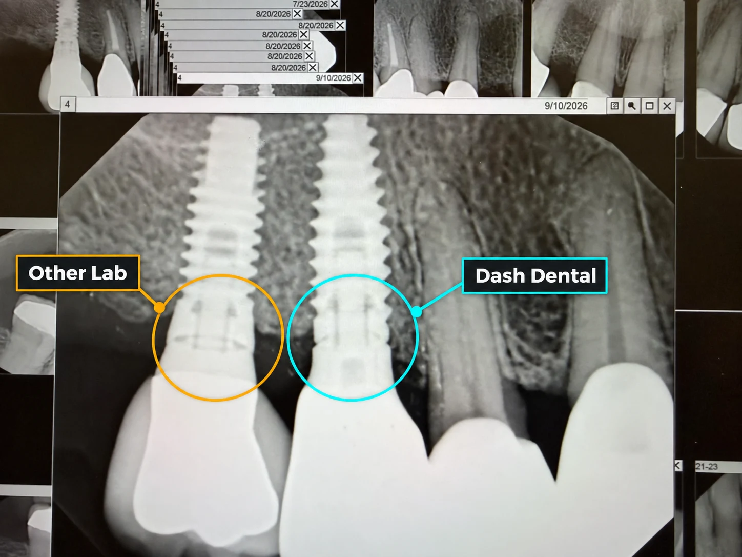 A detail from Dash’s implant case documentation