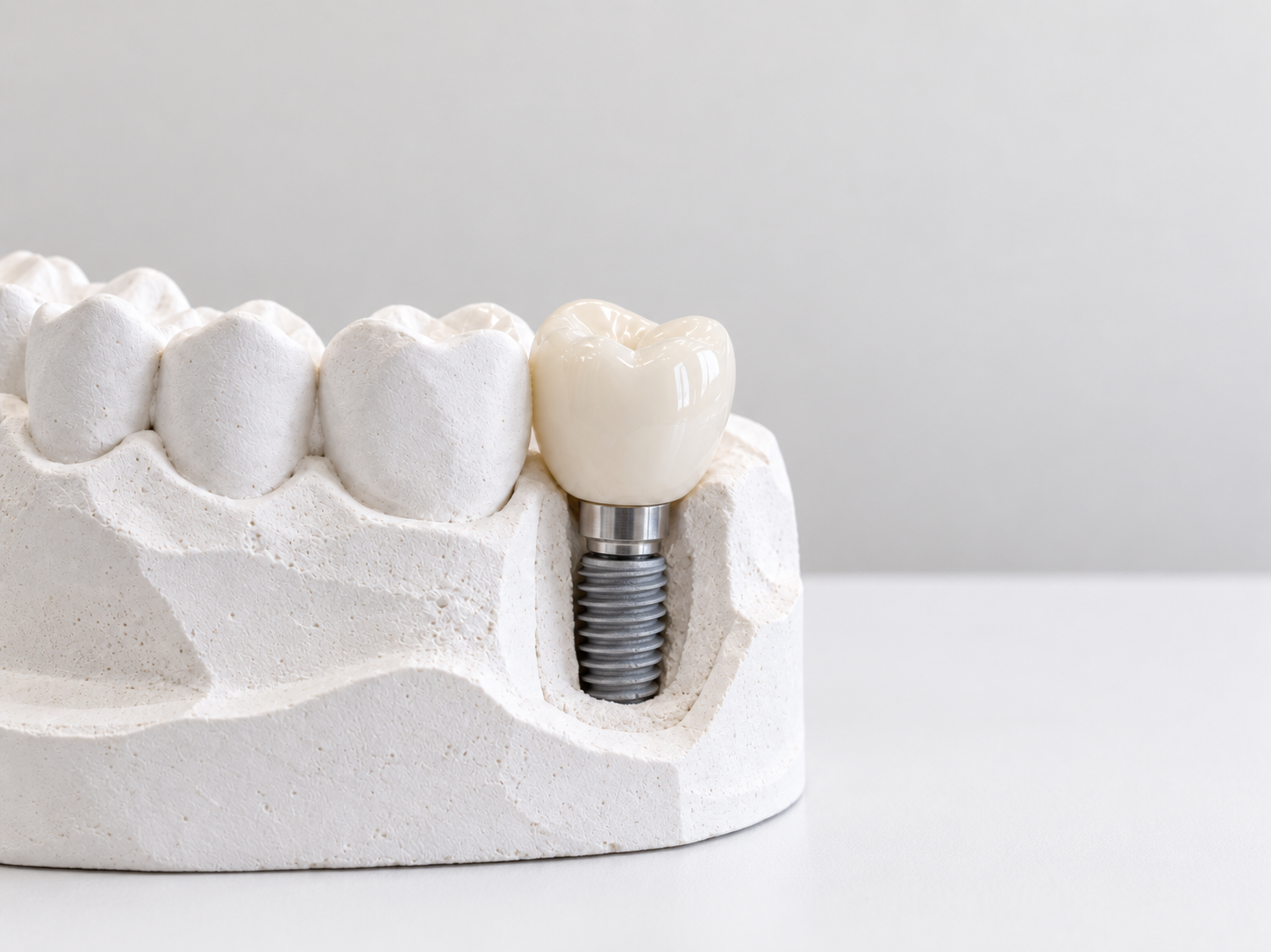 Dental model showing a crown supported by an implant