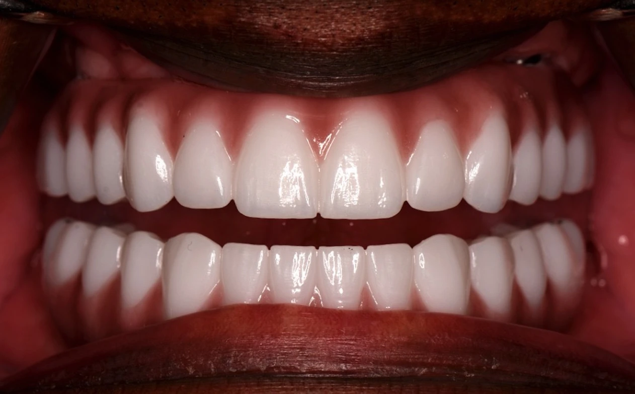 Close-up of a completed Dash smile restoration